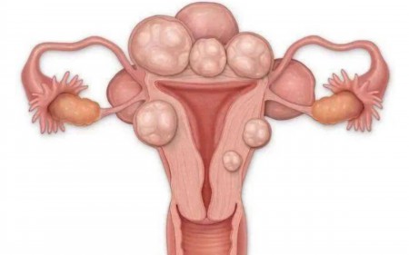 多囊卵巢到40岁就逐渐好了吗，昆凌多囊卵巢综合征怎么治好的